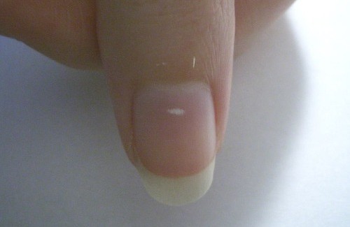 Что означают белые пятнышки на ногтях?