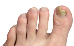 Онихомикоз: грибок ногтей