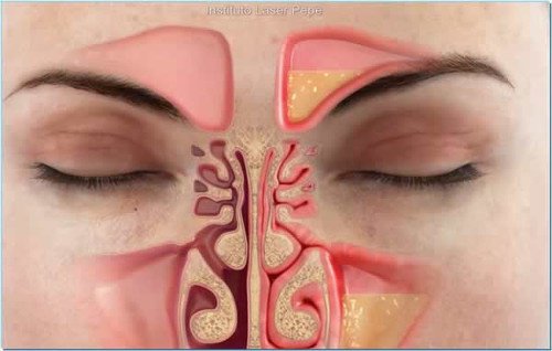 Как уменьшить заложенность носа за одну минуту