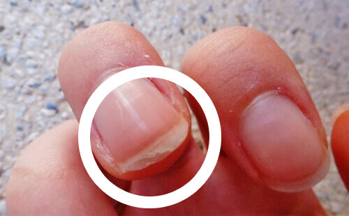 Почему расслаиваются ногти? Причины, средства лечения и решения проблемы